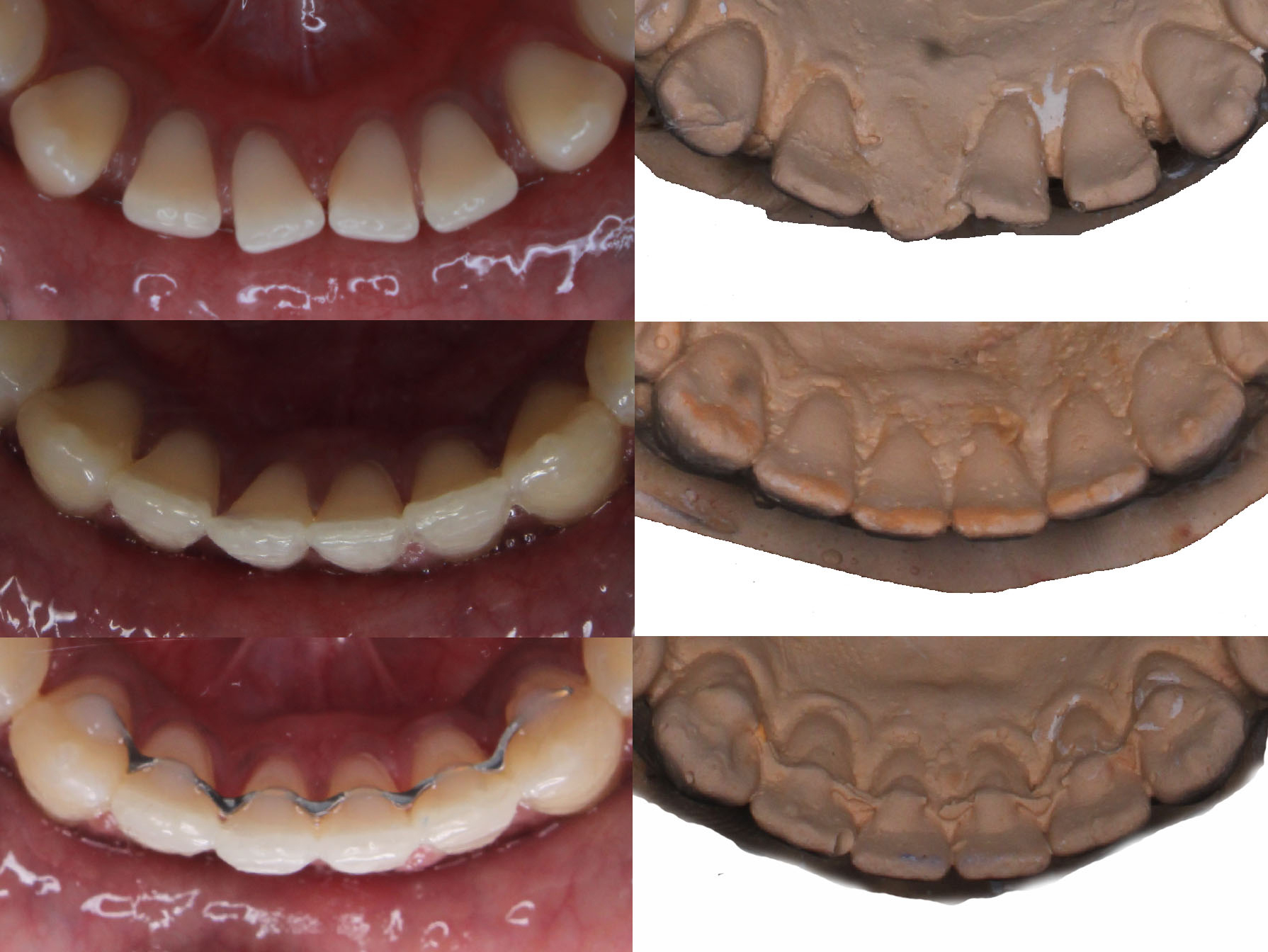 Representative cast images and their equivalent clinical
photographs of the interproximal contacts at pre-treatment, post treatment and
one-year post treatment of the mandibular anterior region.