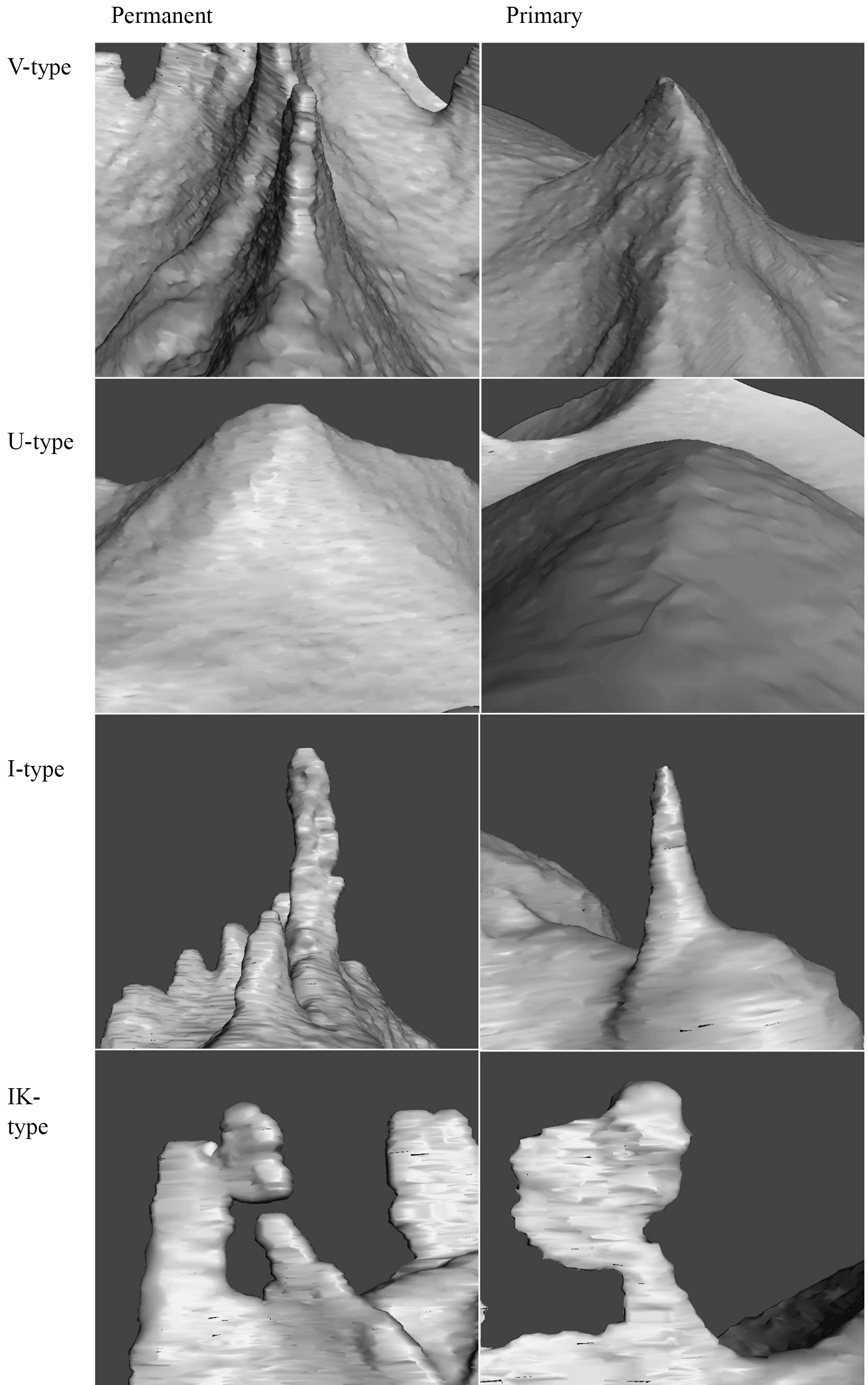 Different fissure types in primary and permanent molars.