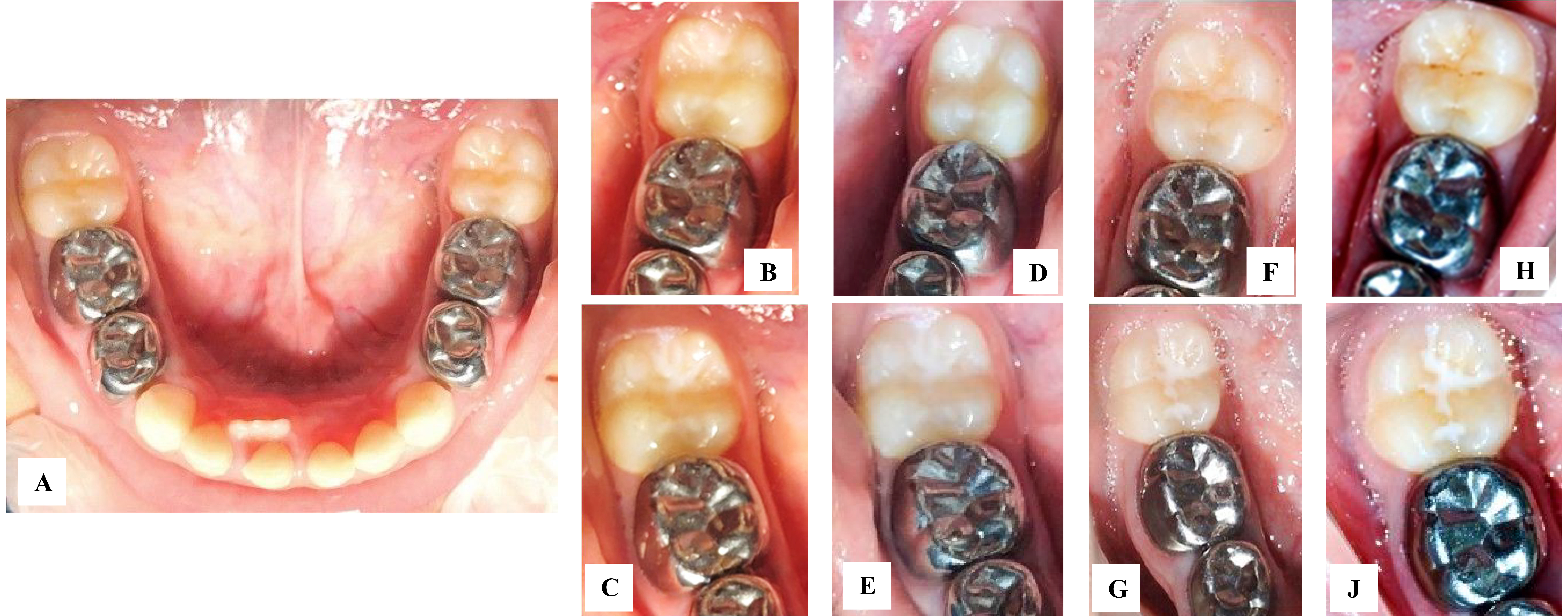 Intraoral photographs showing retention and caries scores from
baseline up to 12-months follow-up. Retention and caries scores for teeth #36
(hydrophobic sealant) and #46 (hydrophilic sealant). A: sound fissures at
baseline in teeth #36 and #46. B,C: sealants at baseline in teeth #36 and
#46. D: sealant present on >50% of fissure pattern (score B) with no caries
(score 0) #36; E: sealant present on all fissure pattern (score A) with no
caries (score 0) #46—at the three months follow-up. F: sealant present on
<50% of fissure pattern (score C) with initial enamel caries (score1) #36; G:
sealant presaent on all fissure pattern (score A) with no caries (score 0)
#46—at the six-months follow-up. H: no sealant present (score D) with enamel
caries (score 2) #36; J: sealant present on >50% of fissure pattern (score B)
with no caries (score 0) #46—at the twelve months follow-up.
