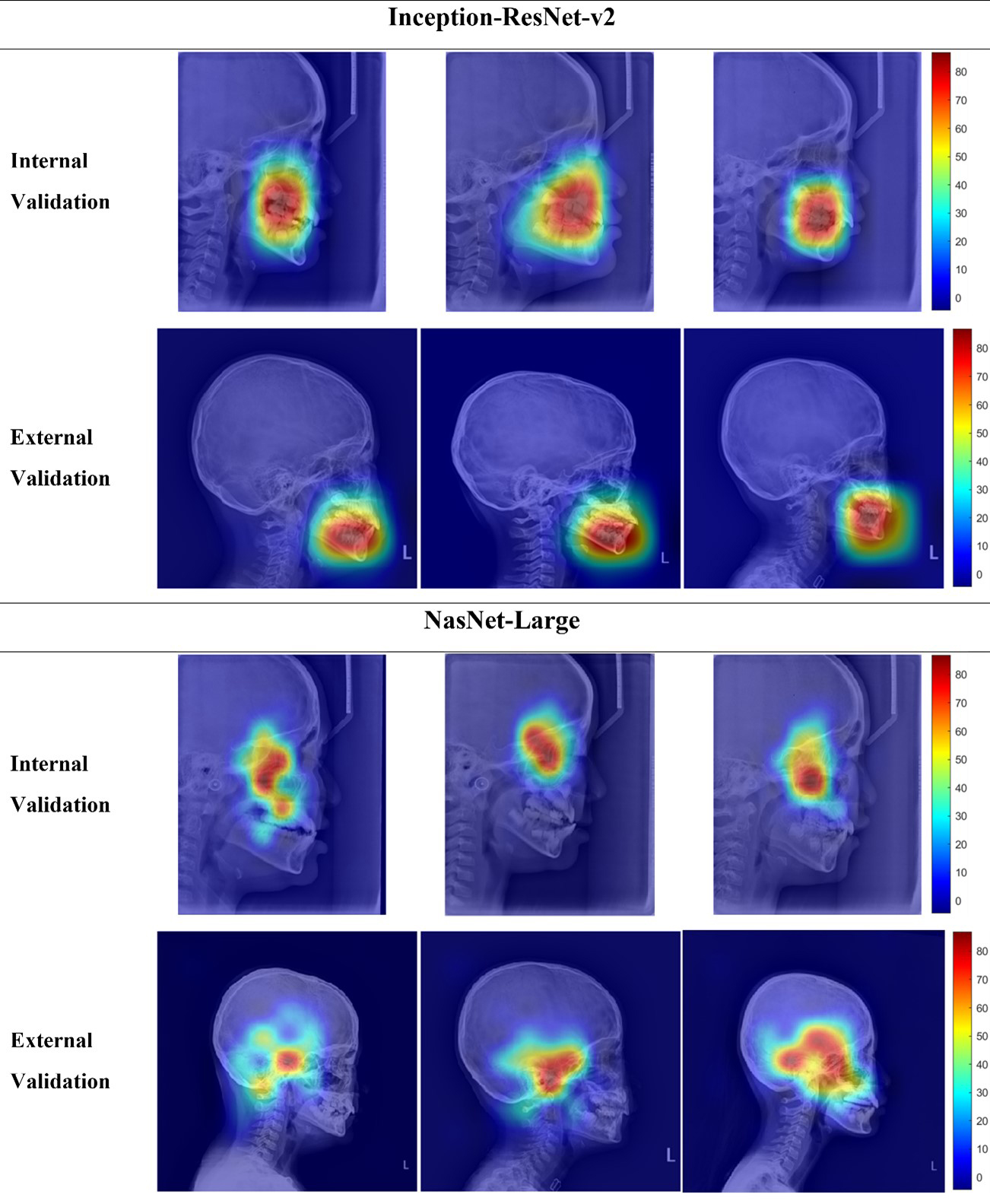 Grad-RAM images of the lateral cephalometric
radiographs (LCRs) during the internal and external validation. In this case,
the InceptionResNet-v2 model (top images) mainly focused on facial bones,
including dentition, while the NasNet-Large model (bottom images) mainly focused
on the cranial base and midfacial bones.