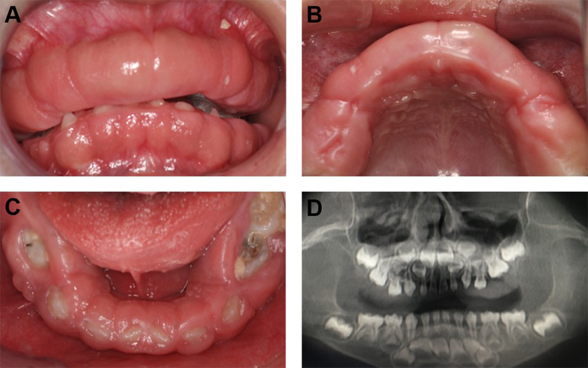 Oral manifestations of the proband. The frontal, lower arch and
up occlusal view, which show diffuse overgrowth of the gingiva involving both the
maxillary and mandibular arches (A–C); Panoramic radiograph showing normal teeth
for the child’s chronological age (D).