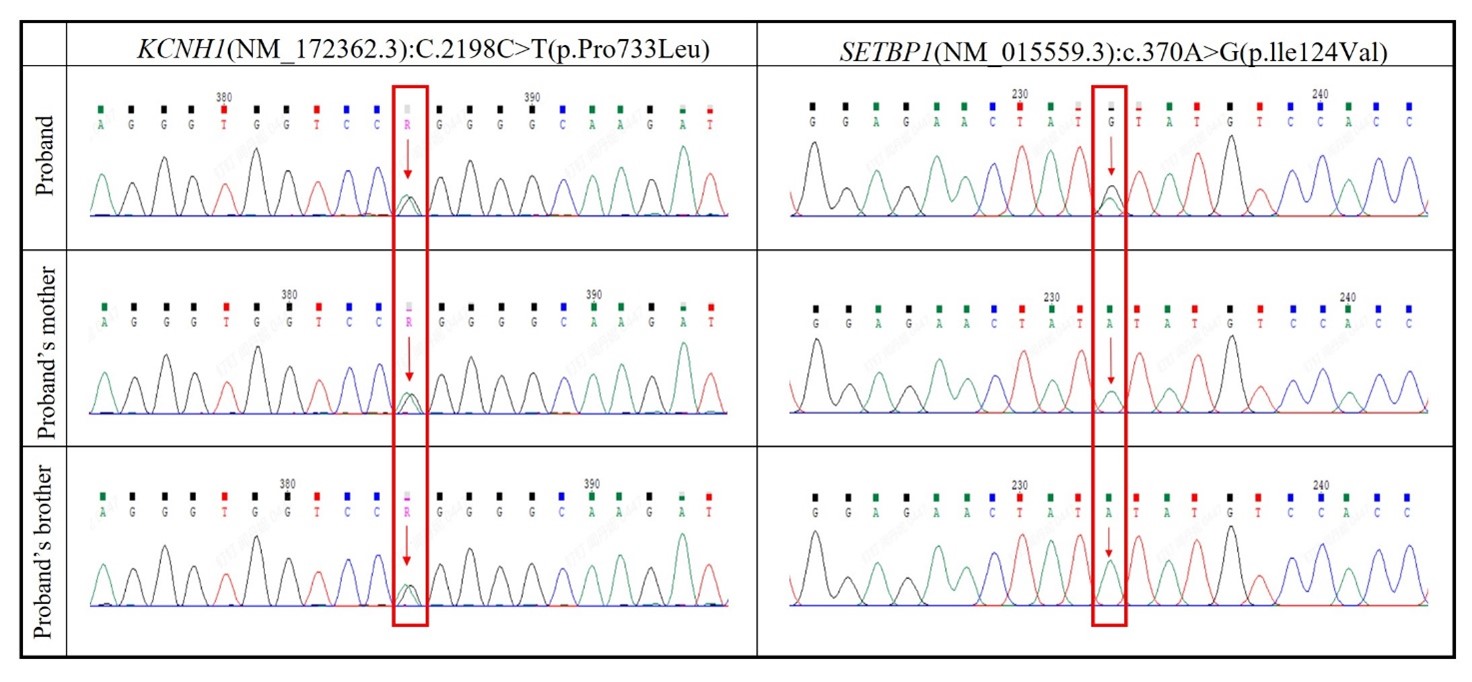 Genetic analysis of the family. Sequencing chromatographs of
genomic DNA reveals heterozygous missense mutations—c.2198C>T of the
KCNH1 (potassium channel, voltage-gated, subfamily H, member-1) gene in
the proband, his mother and his brother. Mutations—c.370A>G of the
SETBP1 (SET binding protein 1) gene only in the proband.