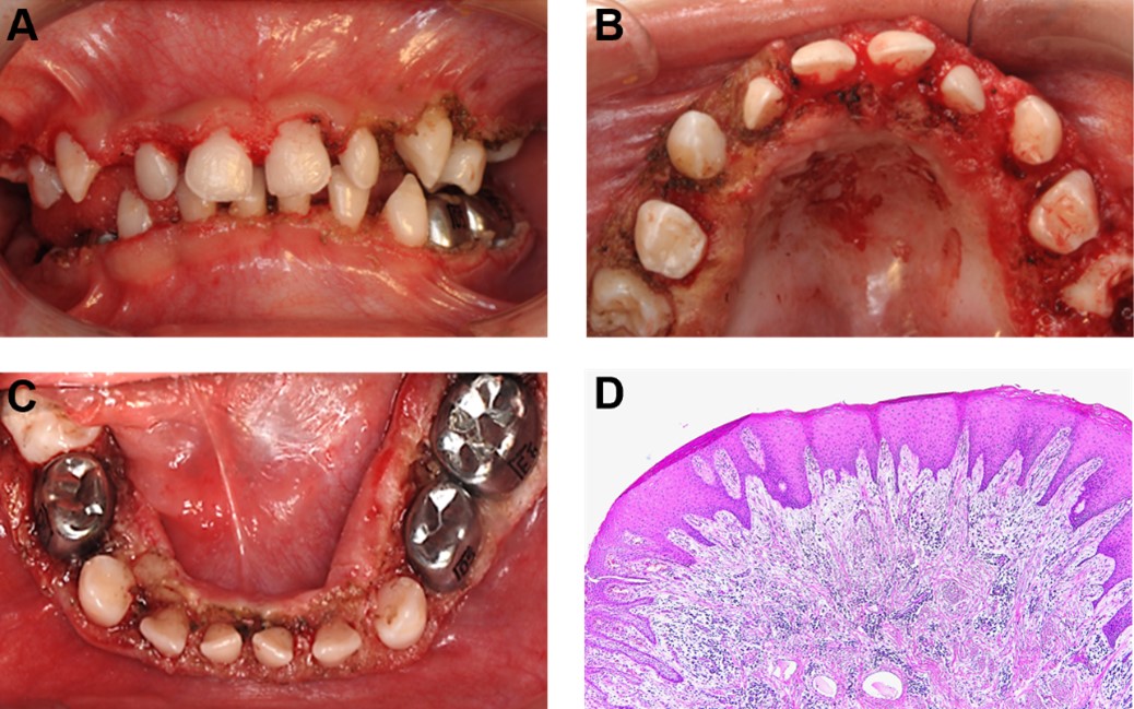 Post-operative photo and pathological presentation. Immediately after surgery, which show that full exposure of maxillary and
mandibular dentition (A–C); Epithelium is thickened and displays narrow,
elongated rete pegs that penetrate deep into the connective tissue (H&E
staining, ×4) (D).