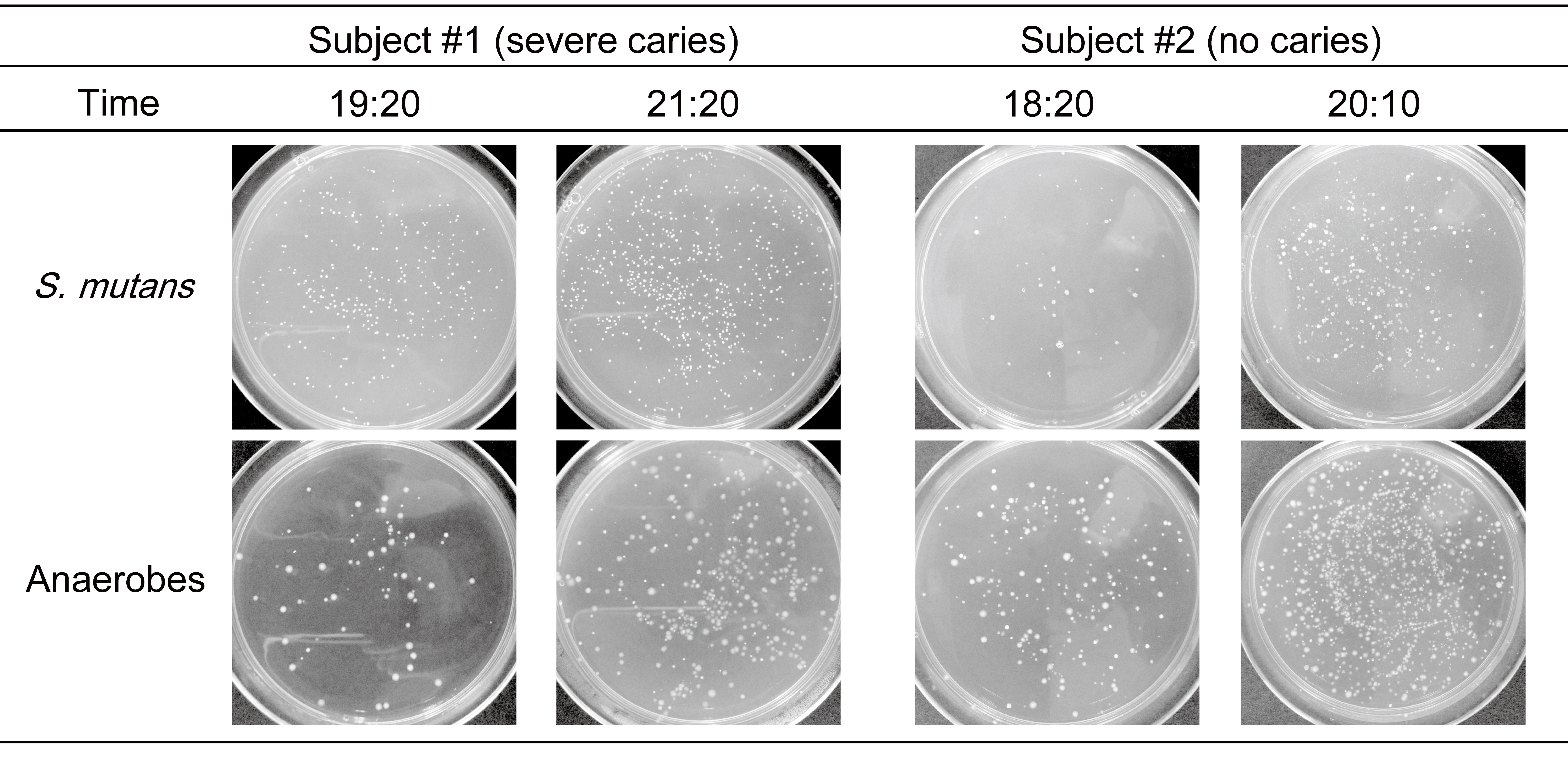 The representative culture plates of S. mutans and
anaerobes. Whole saliva collected at the indicated times was cultured for 24
hours. Resultant plates from the two subjects (with severe caries and no caries)
are shown. Upper images show the culture for S. mutans with selective
medium, and the lower images show the culture for anaerobes. S. mutans:
Streptococcus mutans.