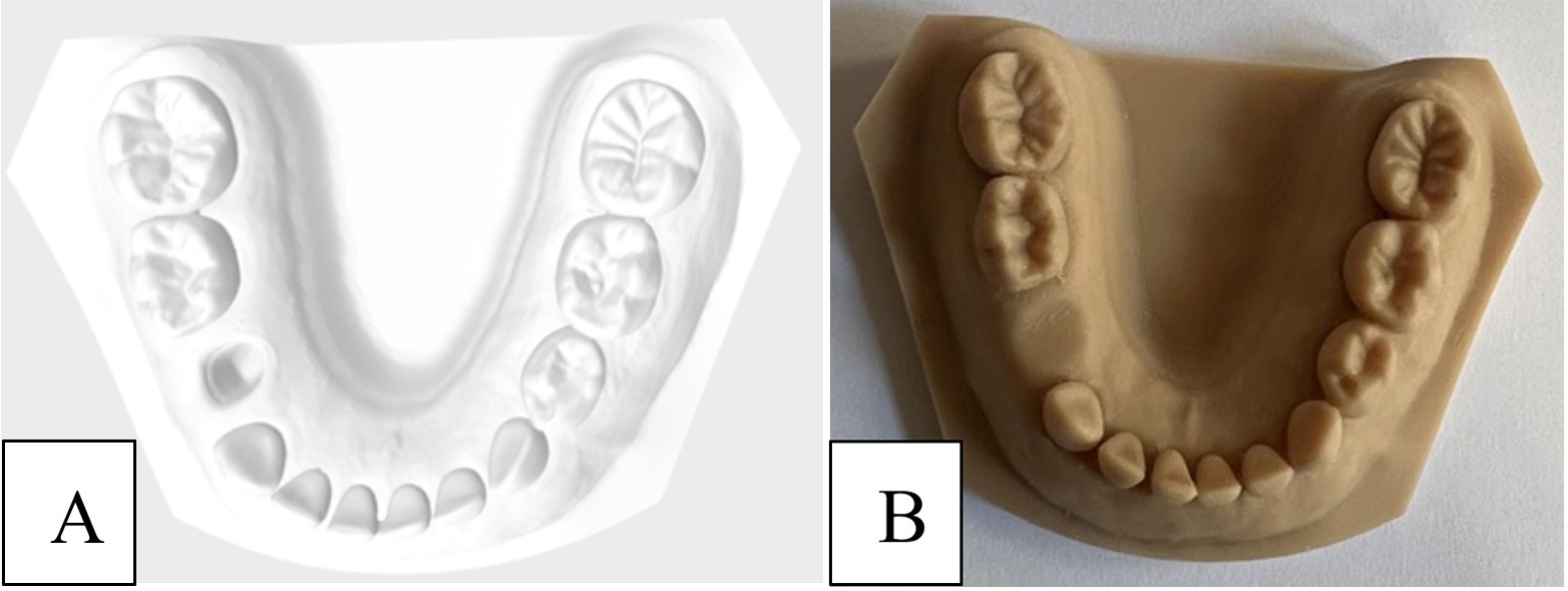 Master models. (A) Digital impression obtained by using
intraoral scanners (Trios 5, 3Shape, Copenhagen, Denmark). (B) 3D-printed master
model produced with SLA technology (Formlabs Form 3B; Formlabs Inc, Sommerville,
MA) and model resin.