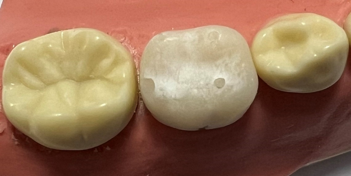 Prosthetic restorations unpolished 3D-printed restoration for
primary molars using a 3D printer (Formlabs Form 3B; Formlabs Inc, Sommerville,
MA, USA) and printed resin material for definitive prostheses (Formlabs, Formlabs
Inc, Sommerville, MA, USA).