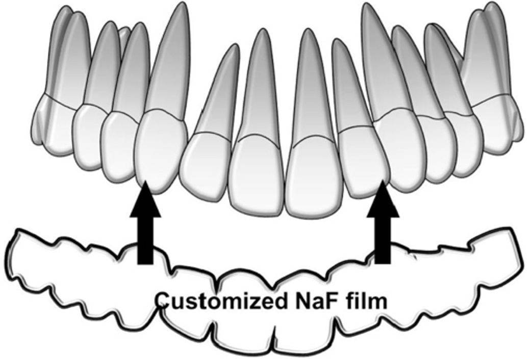 Fluoride application Fluoride adhesive film made by 3D printer 
is attached to the labial/buccal surface of the teeth [67]. NaF: Sodium fluoride.