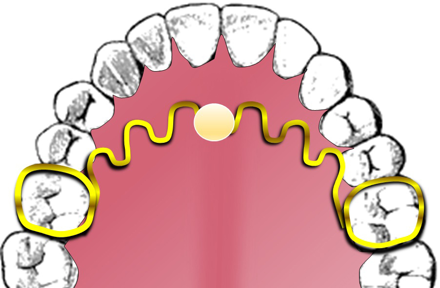 A tongue crib appliance with an acrylic ball is needed for AS
correction.