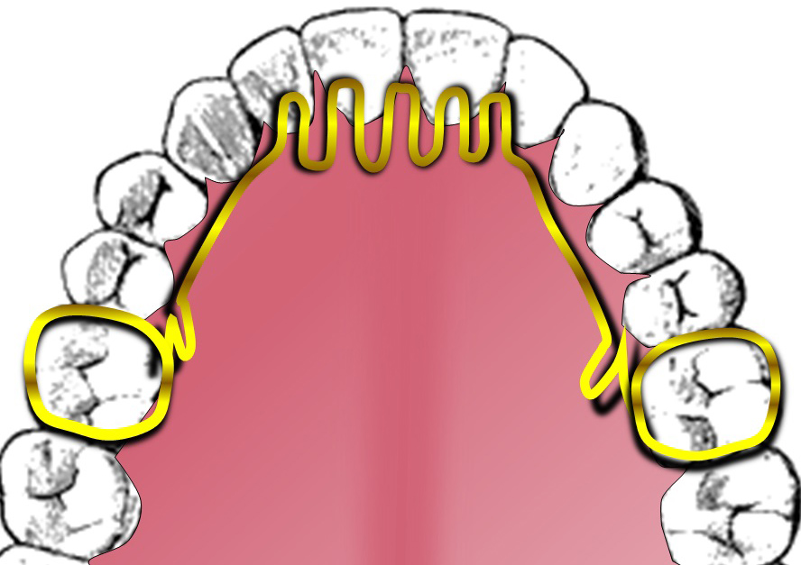 Example of tongue crib appliance.