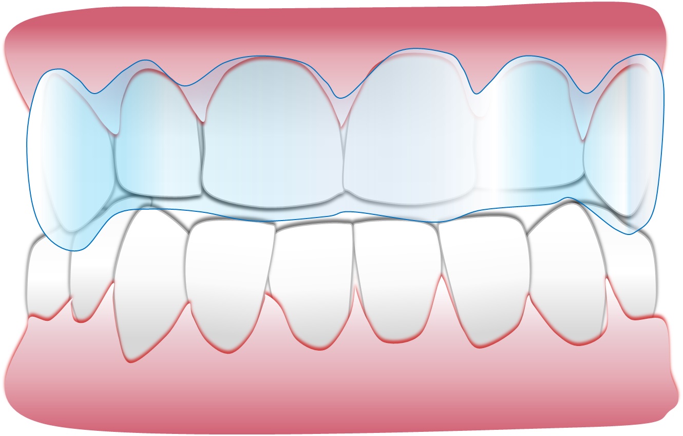 Soft tongue restrainer.