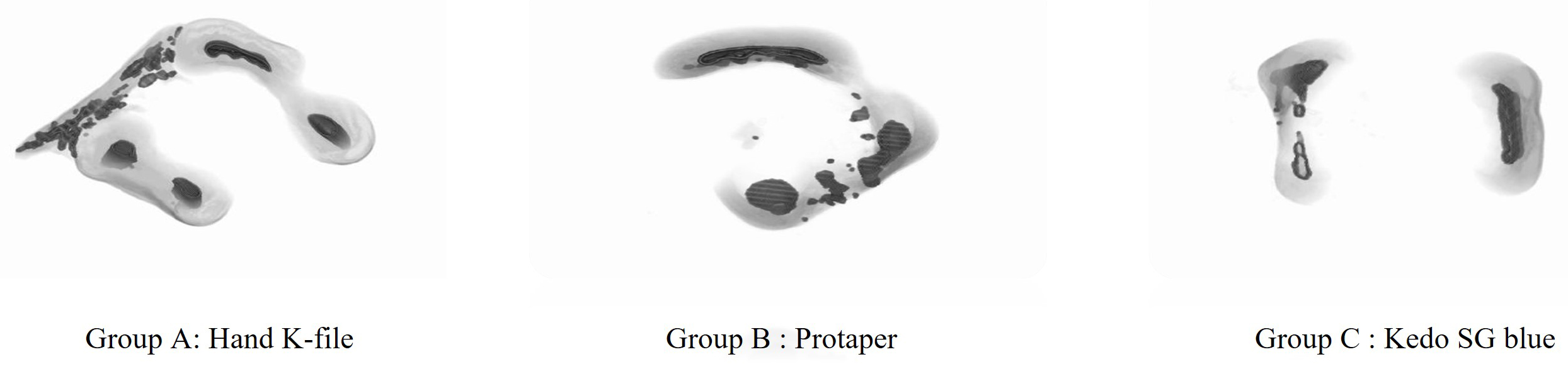 Pre-operative volumetric analysis.