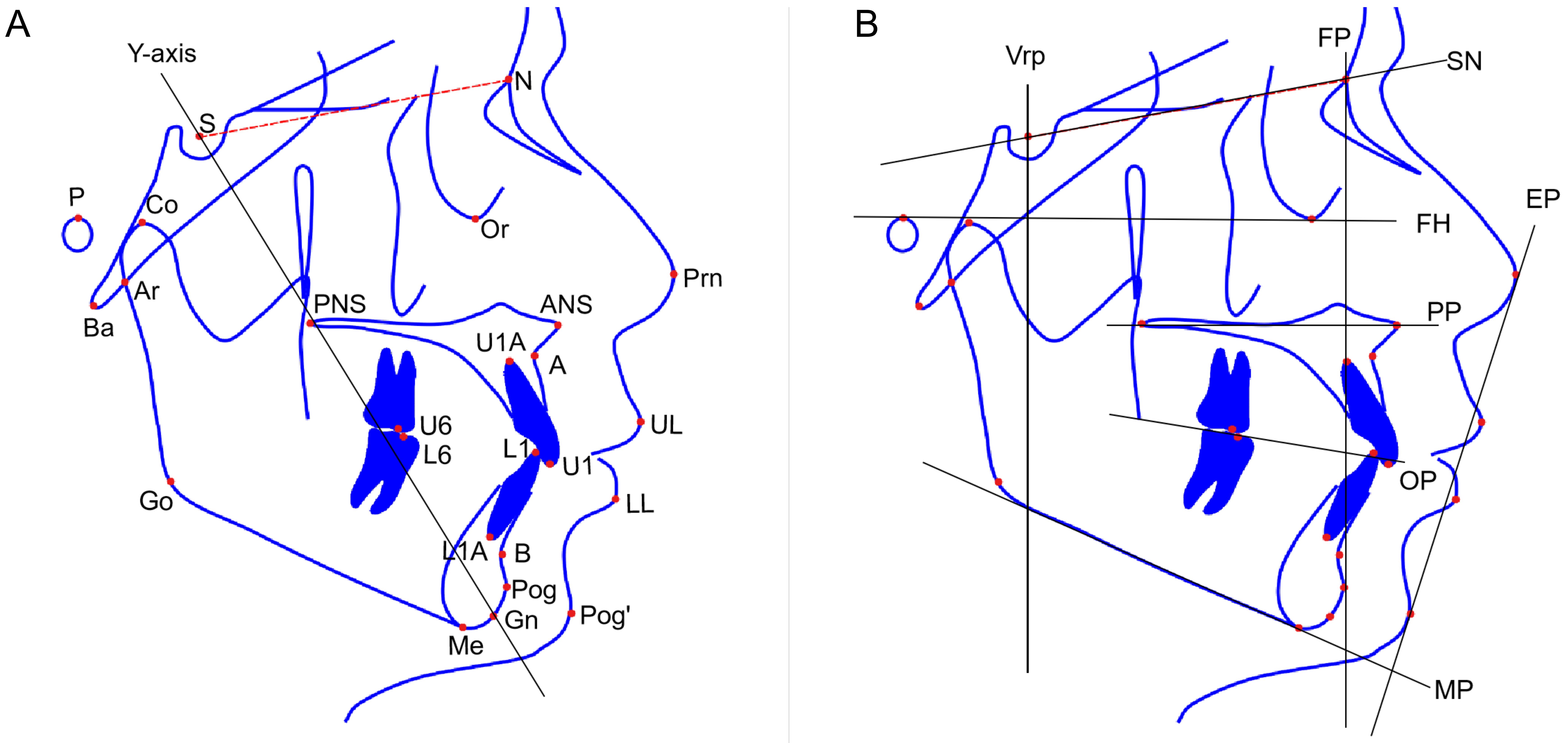Cephalometric measurements used in this study. (A) reference 
points; (B) reference lines. Abbreviations: Nasion (N), sella point (S), 
condylion (Co), articulare (Ar), basion (Ba), gonion (Go), anterior nasal spine 
(ANS), posterior nasal spine (PNS), point A (A), point B (B), pogonion (Pog), 
soft tissue pogonion (Pog’), gnathion (Gn), menton (Me), subnasale (Sn), labrale 
superius (UL), labrale inferius (LL) , upper incisor edge (U1), upper incisor 
apex (U1A), lower incisor edge (L1), lower incisor apex (L1A), porions (P), 
orbitale (Or), pronasale (Prn), the midpoint of mesial cusps of upper first 
molars (U6) and lower first molar (L6).