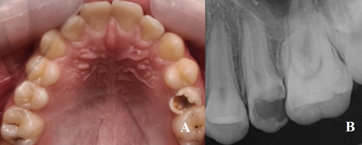 Preoperative intraoral and radiographic views of the patient. 
(A) Preoperative intraoral view. (B) Preoperative radiographic view.