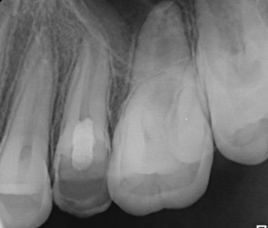 Intraoral radiograph of 
the inserted WMTA.