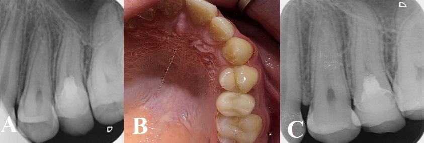 3D-printed endocrown follow-up views. (A) 1-year follow-up radiograph. 
(B) 2-year follow-up intraoral view. (C) 2-year follow-up radiograph.