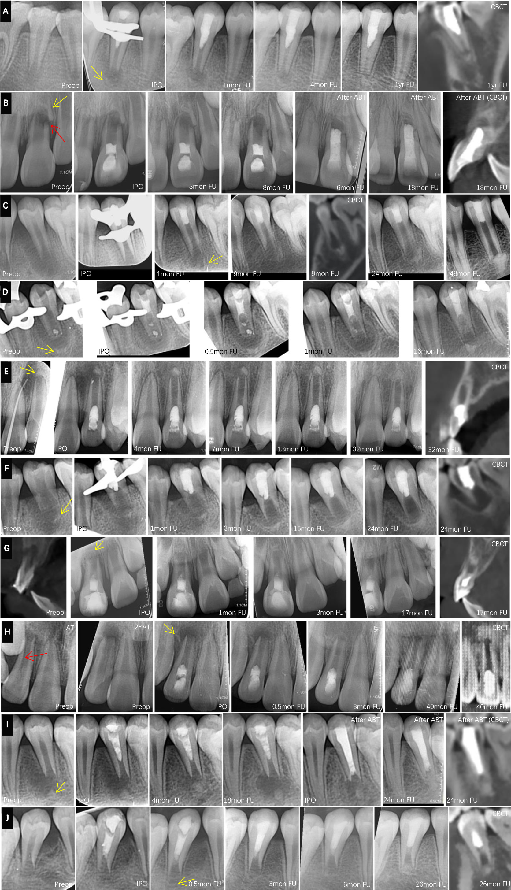 Periapical radiograph of ten cases. (A) Case 1, (B) Case 2, (C)
Case 3, (D) Case 4, (E) Case 5, (F) Case 6, (G) Case 7, (H) Case 8, (I) Case 9,
(J) Case 10. The red arrow in (B) and (H) indicates the presence of a fracture
line. The yellow arrow in (A-J) indicates the initial occurrence of apical
radiopaque tissue. Preop, preoperative; IPO, immediate postoperative; FU,
follow-up; ABT, apical barrier technique; IAT, immediately after trauma; 2YAT,
two years after trauma.