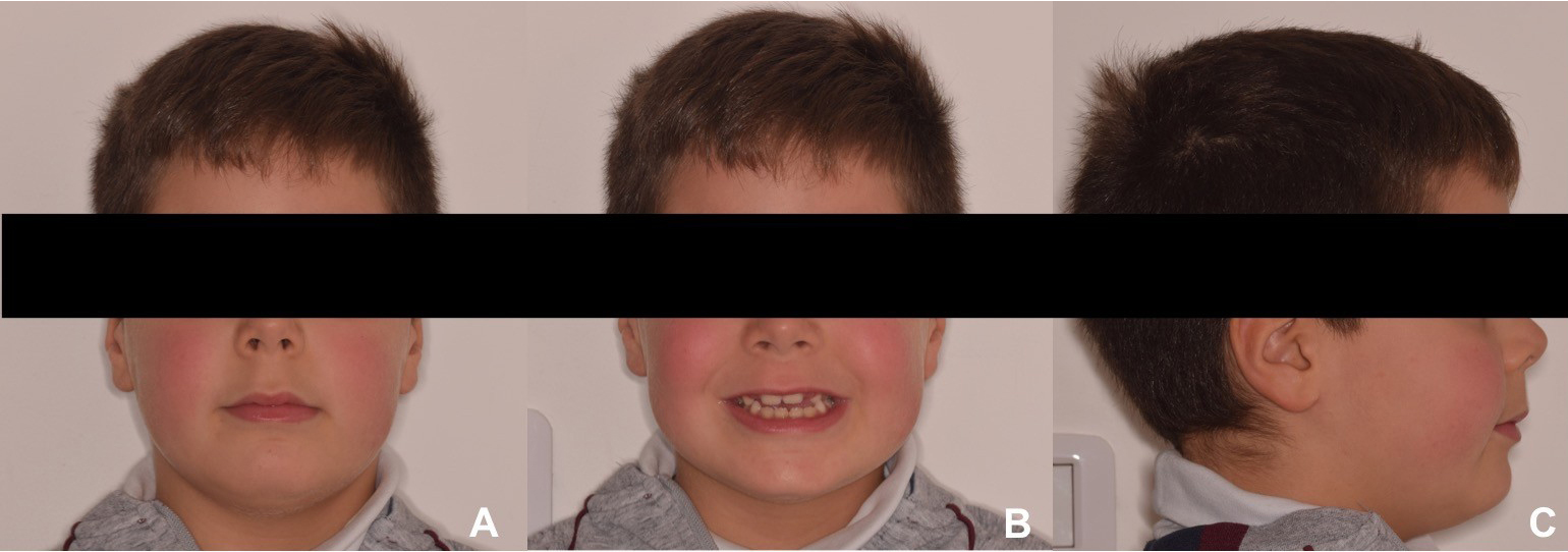 Extra-oral photographs of a male child presenting FPXB. (A) 
Frontal view in the rest position. (B) Frontal view while smiling. (C) Right 
profile view.