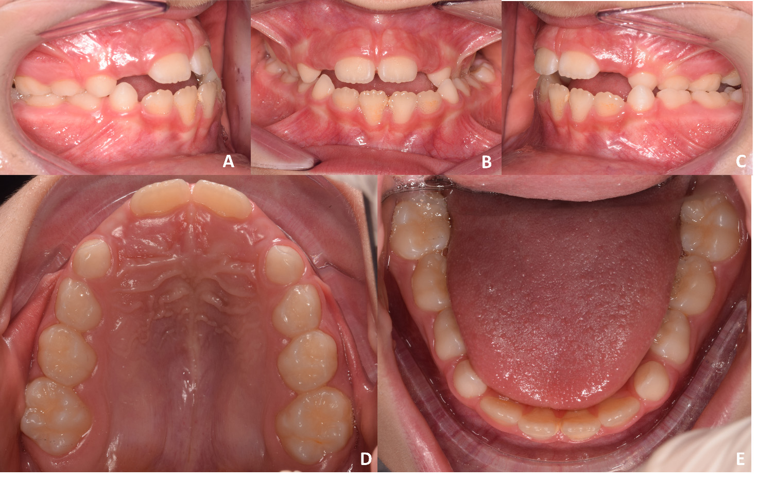 Intra-oral photographs of a male child presenting FPXB. (A) 
Right lateral view. (B) Frontal view. (C) Left lateral view. (D) Upper occlusal 
view. (E) Lower occlusal view.