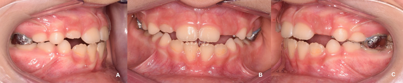 Intra-oral photographs of the post-expansion stage. (A) Right 
lateral view. (B) Frontal view. (C) Left lateral view.