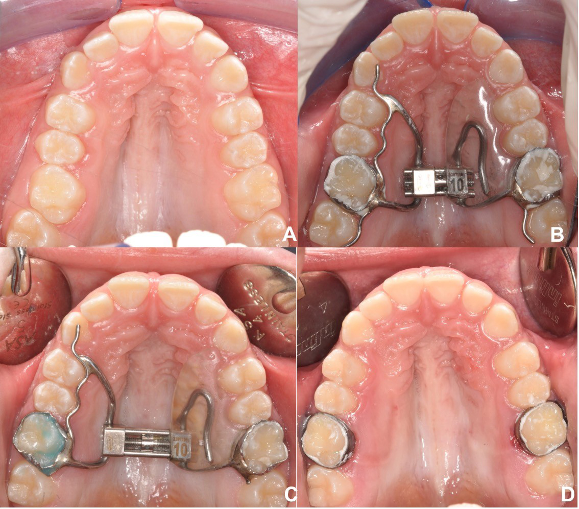 Journal of Clinical Pediatric Dentistry (JOCPD)