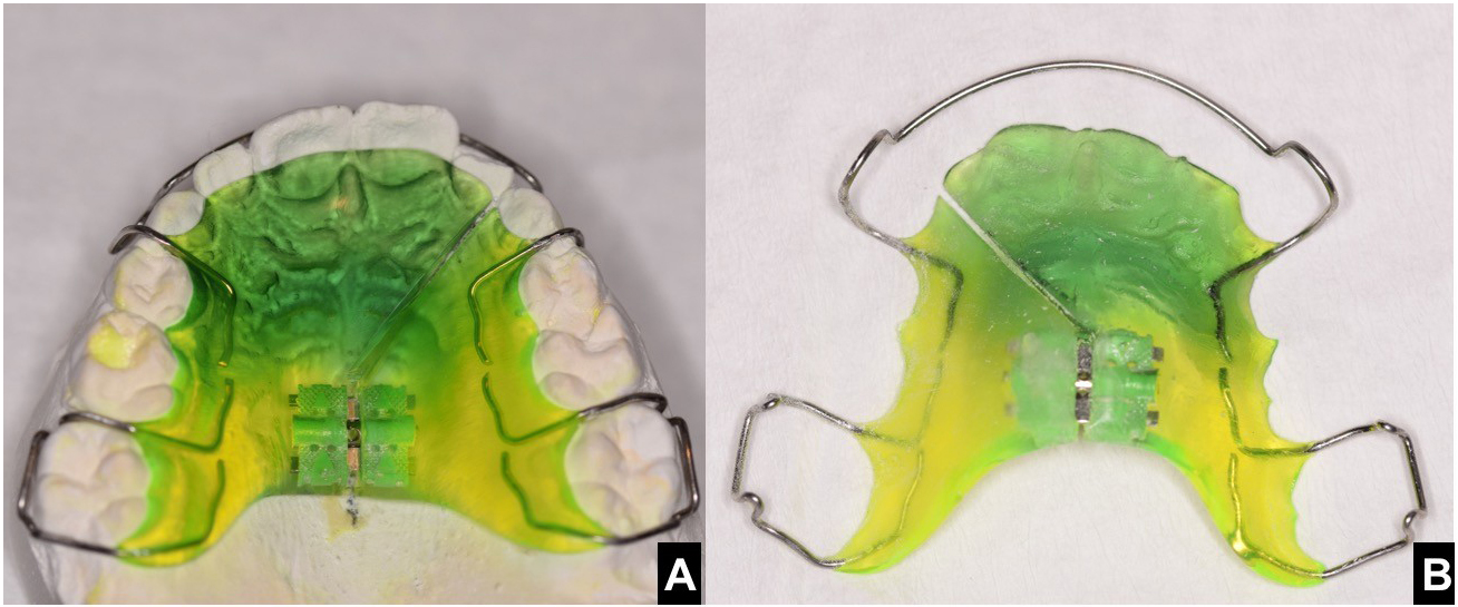 Removable appliance including jackscrew can be a valid 
alternative. (A) Occlusal view. (B) Inner view.
