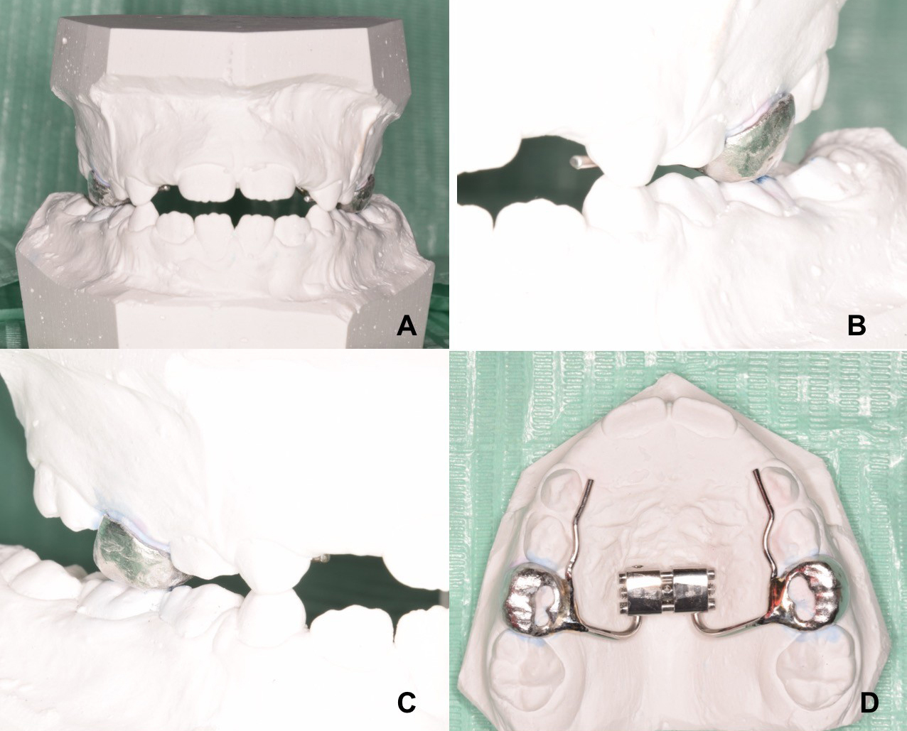 Example of customized CAD-CAM molar bands for maxillary 
expansion. (A–C) Occlusal metal bite-block can help increase the efficiency of 
the crossbite correction since it is possible to start the expansion from the CR 
without the of presence occlusal interferences. (D) Occlusal view of metal bites 
block included into the customized bands.