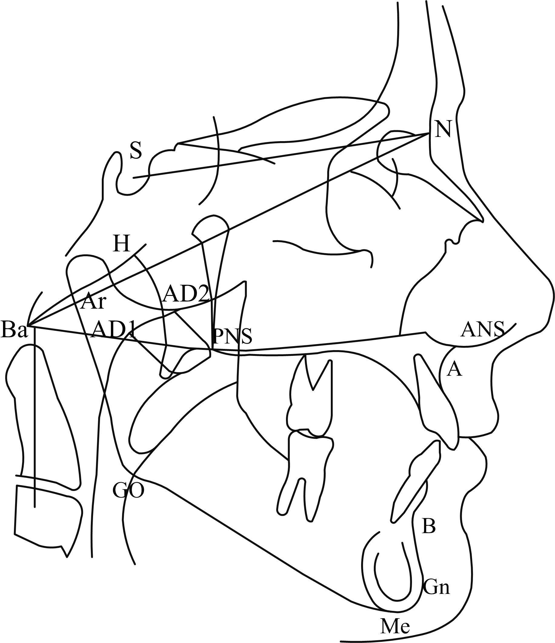 Traces of the anatomical structure of the tooth surface, soft
tissues and cephalic measurement points. The head diagram illustrates the angular
head measurement. The tooth surface structure and soft tissue were traced by
hand, and the following angles and linear head measurements were obtained by head
measurement tracking. S: sella; N: nasion; ANS:
anterior nasal spine; PNS: posterior nasal spine; Ar: articulare; Go: gonion; Gn:
gnathion; Me: menton; H: Hormion, point located at the intersection between the
perpendicular line to Sella-Basion from posterior nasal spine and the cranial
base; Ba: Basion; PNS-AD1: distance between the closest adenoid tissue and
posterior nasal spine measured through the PNS-Ba line (AD1); PNS-AD2: distance
between the closest adenoid tissue and the posterior nasal spine and measured
through a perpendicular line to Sella-Basion from the posterior nasal spine
(AD2); AD2-H: soft-tissue width at the posterior nasopharynx wall through the
posterior nasal spine-Hormion line; AD1-Ba: soft-tissue width at the posterior
nasopharynx wall through the posterior nasal spine-Basion
line.