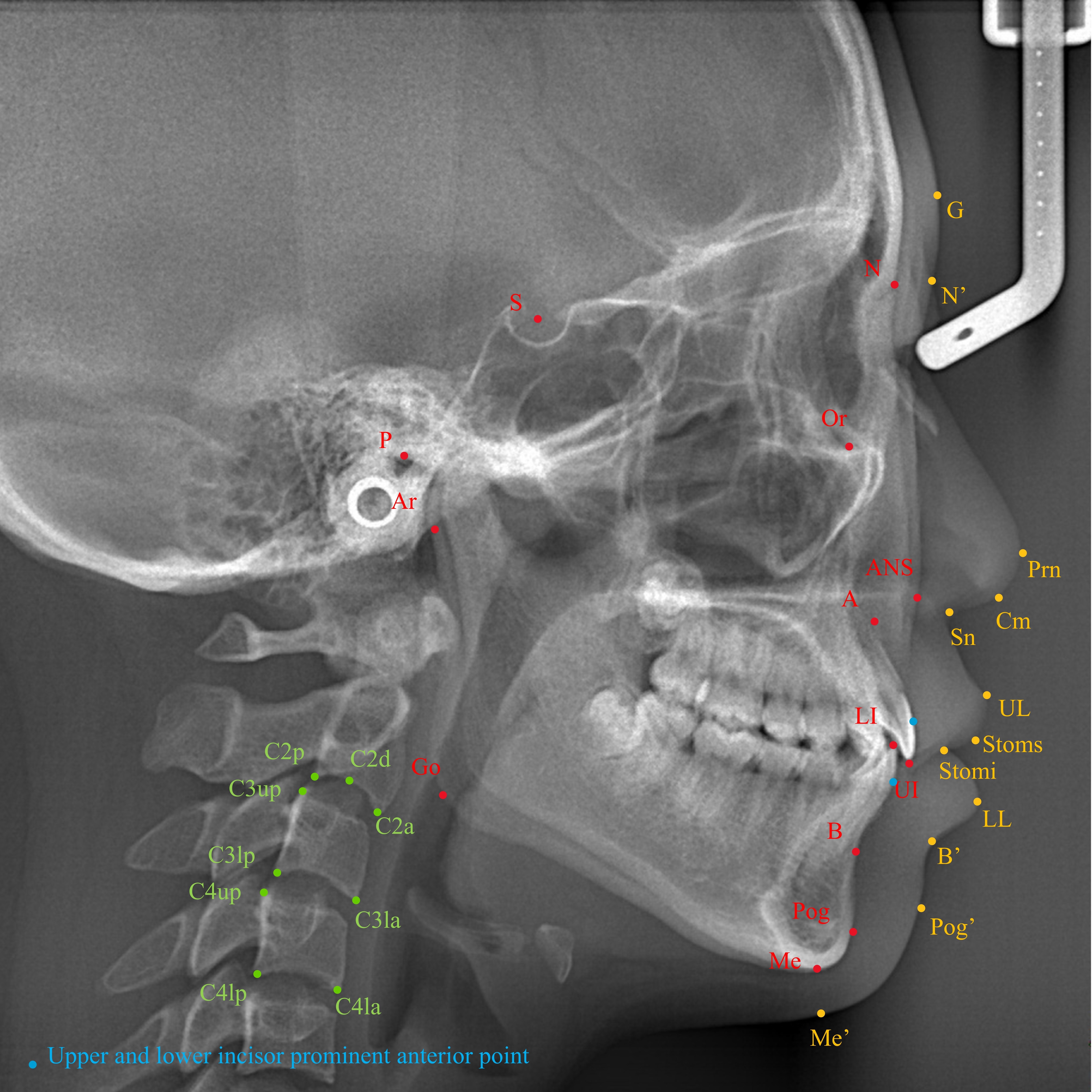 Hard tissue and soft tissue landmarks and measuring points used
in the quantitative cervical vertebral maturation analysis on lateral
cephalogram. Red and blue dots show hard tissue landmarks on lateral cephalogram;
yellow dots show soft tissue landmarks; green dots show measuring points used in
the quantitative cervical vertebral maturation analysis. N: nasion; S: sella; P:
porion; Or: orbitale; Ar: articulare; ANS: anterior nasal spine; A: subspinale;
UI: upper incisor; LI: lower incisor; B: supramental; Pog: pogonion; Me: menton;
Go: gonion; G: glabella; N’: nasion of soft tissue; Prn: pronasale; Cm:
columella; Sn: subnasale; UL: upper lip; Stoms: stomion superius; Stomi: stomion
inferius; LL: lower lip; B’: soft tissue B point; Pog’: pogonion of soft tissue;
Me’: menton of soft tissue. C2d: the most superior point of the lower border of
the bodies of C2; C2a, C2p, C3la, C3lp, C4la and C4lp: the most posterior and
most anterior points on the lower border of the bodies of C2, C3 and C4,
respectively; C3up and C4up: the most superior points of the posterior bodies of
C3 and C4.