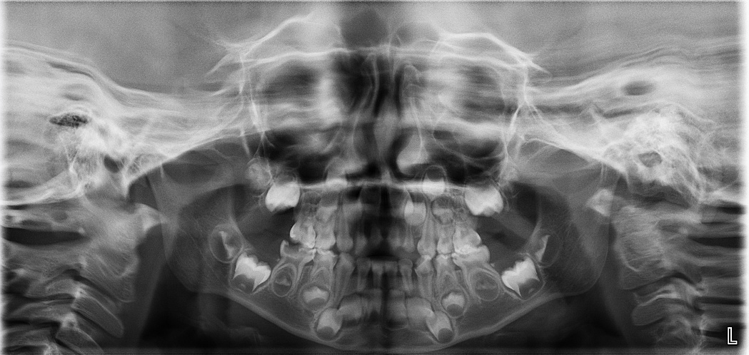 Panoramic image of a 4-year old child presenting adequate clear 
appearances of the posterior teeth germs except maxillary SPs’.