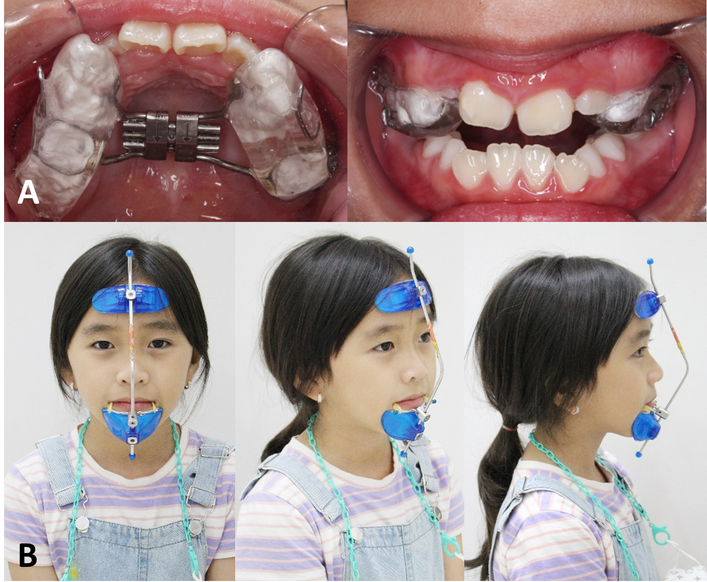Intraoral and extraoral photographs. (A) The initial expansion
procedure; (B) Frontal, and lateral views using a facemask.