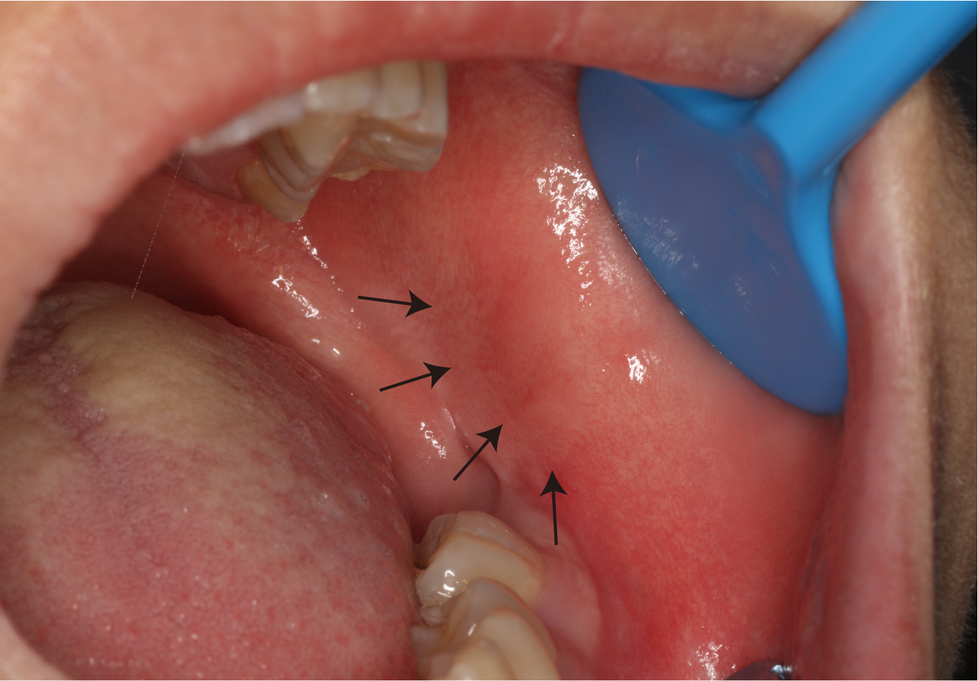Intraoral photo in first visit showing the bulge at buccal side
of retromolar pad (the area indicated by the black arrows).