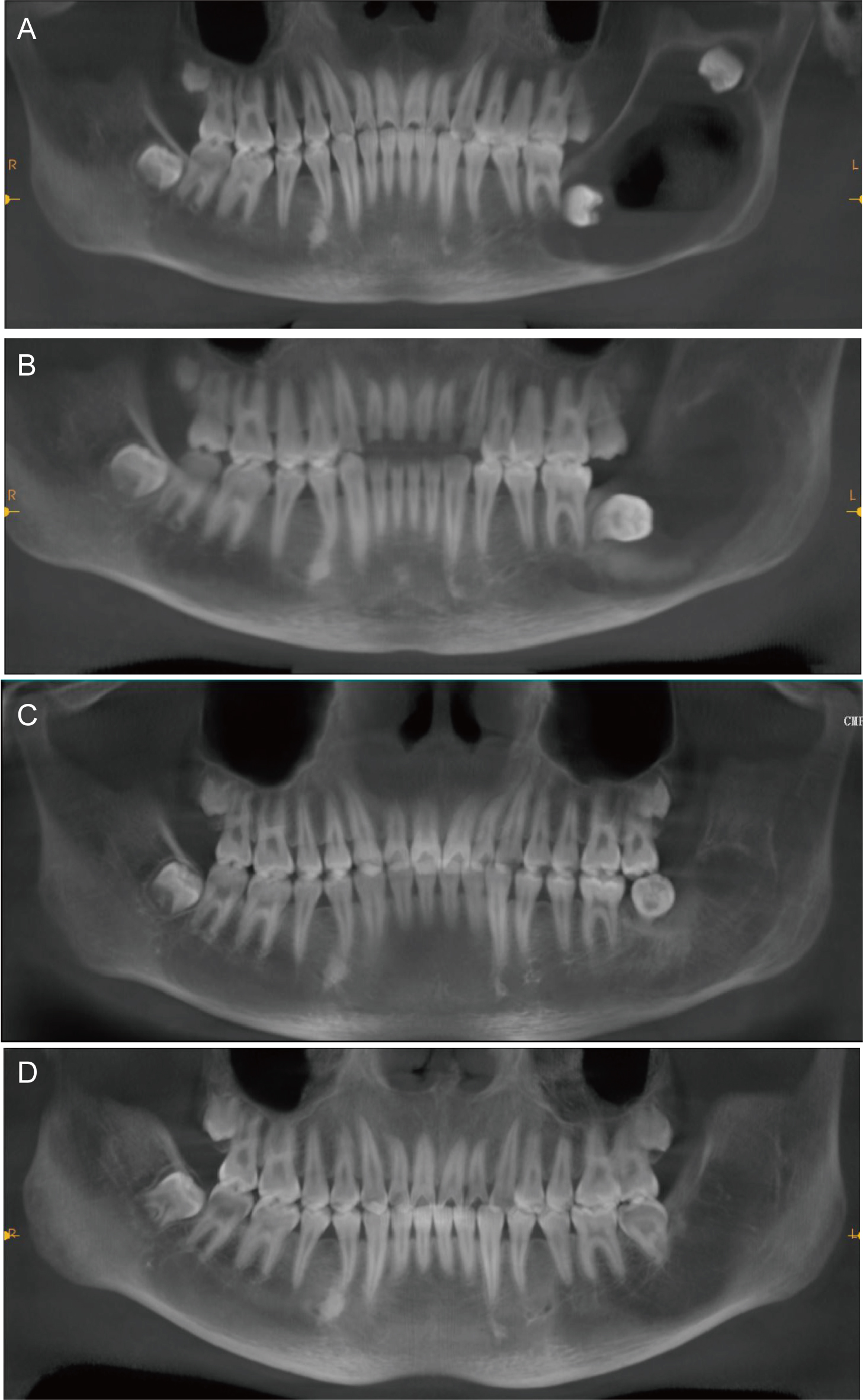 Reconstructed CBCT images in different periods. (A) Preoperative
reconstructed CT images of the mandibular lesion. (B) Reconstructed CT images of
the mandibular lesion three months after the decompression. (C) Reconstructed CT
images of the mandibular lesion ten months after the decompression (before the
secondary enucleation). (D) Reconstructed CT images of the mandibular lesion
eighteen months after the enucleation.