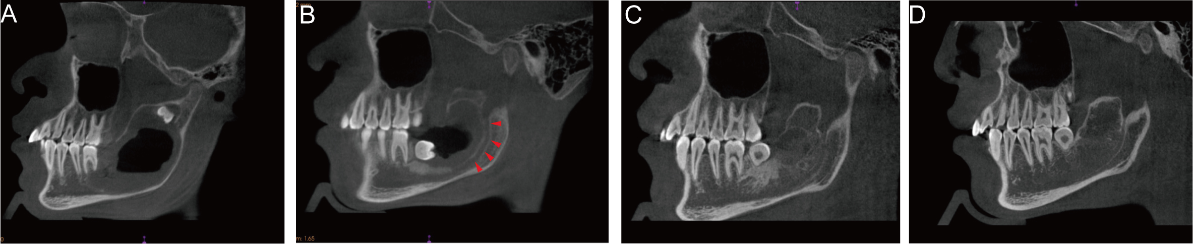 CBCT sagittal view of the left mandible. (A)
Sagittal view of CT image at the first visit. (B) Sagittal view of CT image three
months after the decompression showing the reappearance of mandibular canal. (C)
Sagittal view of CT image ten months after the decompression (before the
enucleation). (D) Sagittal view of CT image eighteen months after the
enucleation.