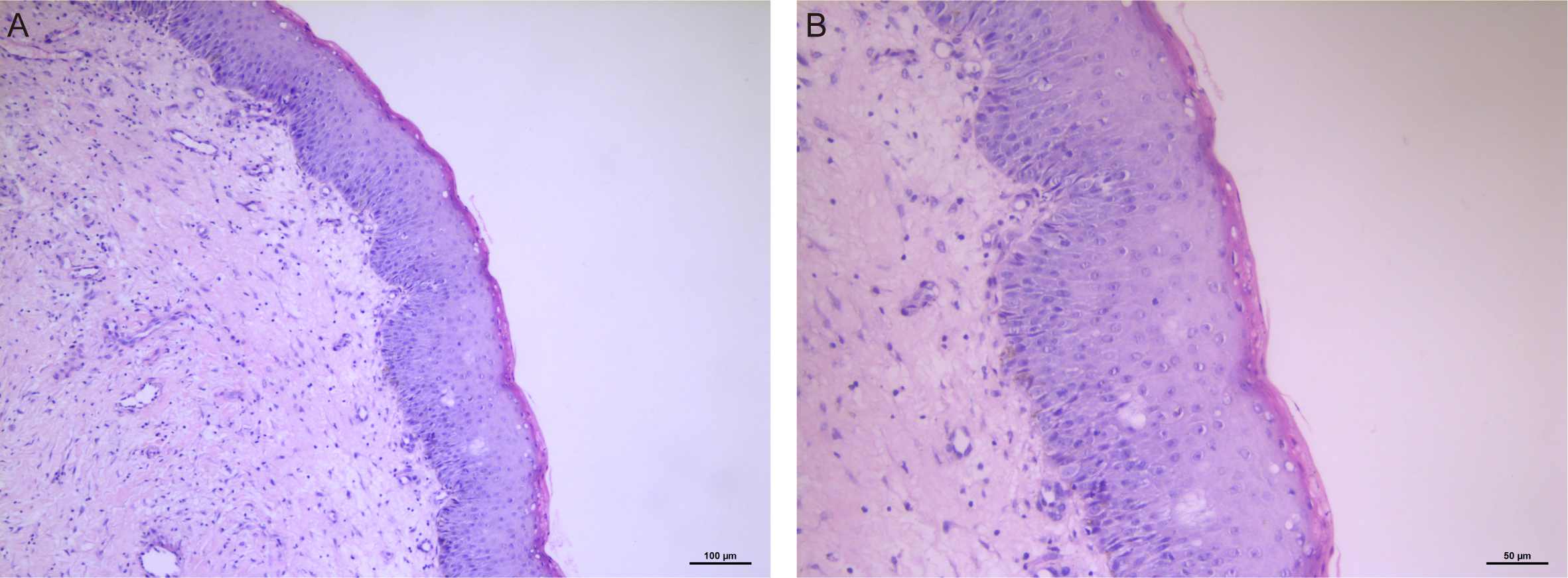 The histopathologic image of lesion. (A) The histopathologic
image of the cystic wall (Hematoxylin and Eosin stain; scale bar, 100 µm).
(B) The histopathologic image of the cystic wall (Hematoxylin and Eosin stain;
scale bar, 50 µm).