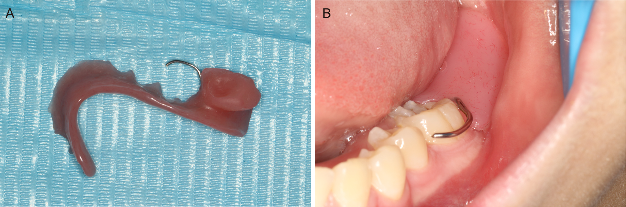 A resin obturator. (A) The obturator like a removable partial
denture. (B) The obturator retained in lower dentition.