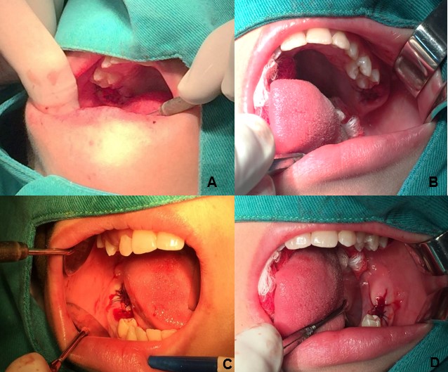 Alveolar region after tooth extraction #16 (A), tooth #26 (B), 
tooth #46 (C) and tooth #36 (D).