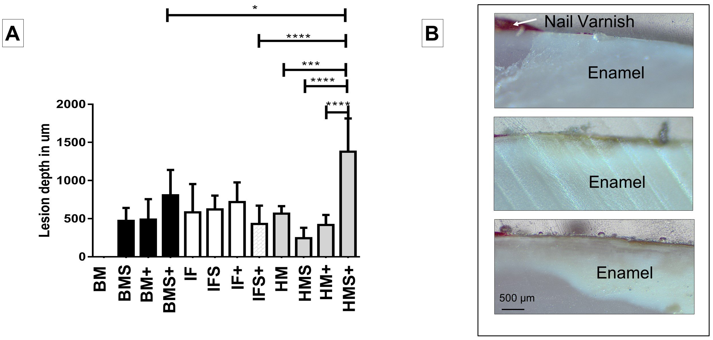 Lesion size results. (A) Milk cultured with/without 10%
sucrose and S. mutans after 2 weeks in sectioned permanent teeth. (B)
Representative sectioned teeth specimens are shown for BM, IF and HM (top to
bottom, respectively) with sucrose added. Scale bar = 500 μm; n = 2;
two-way ANOVA; *p < 0.05; ***p < 0.001;
****p < 0.0001. BM: bovine milk; IF: infant formula; HM:
human milk; S: sucrose; +: S. mutans.