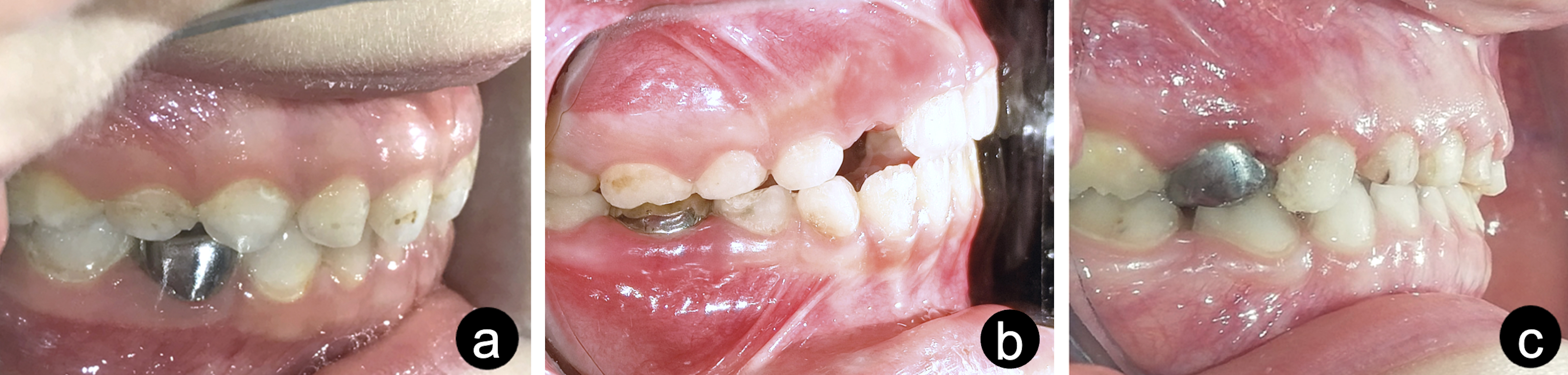 SSCs placed on the lower (a,b) and upper (c) primary first
molars with successful occlusal adaptation.