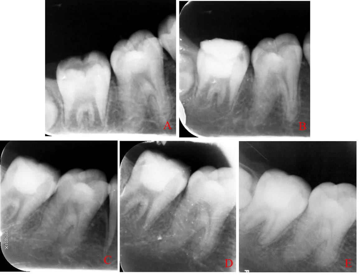 Examples of X-rays taken in non-symptomatic apical periodontitis 
group at the beginning of treatment and during follow-up. (A) initial, (B) 
immediately after surgery, (C) 3 months follow-up, (D) 6 months follow-up, (E) 12 
months follow-up.