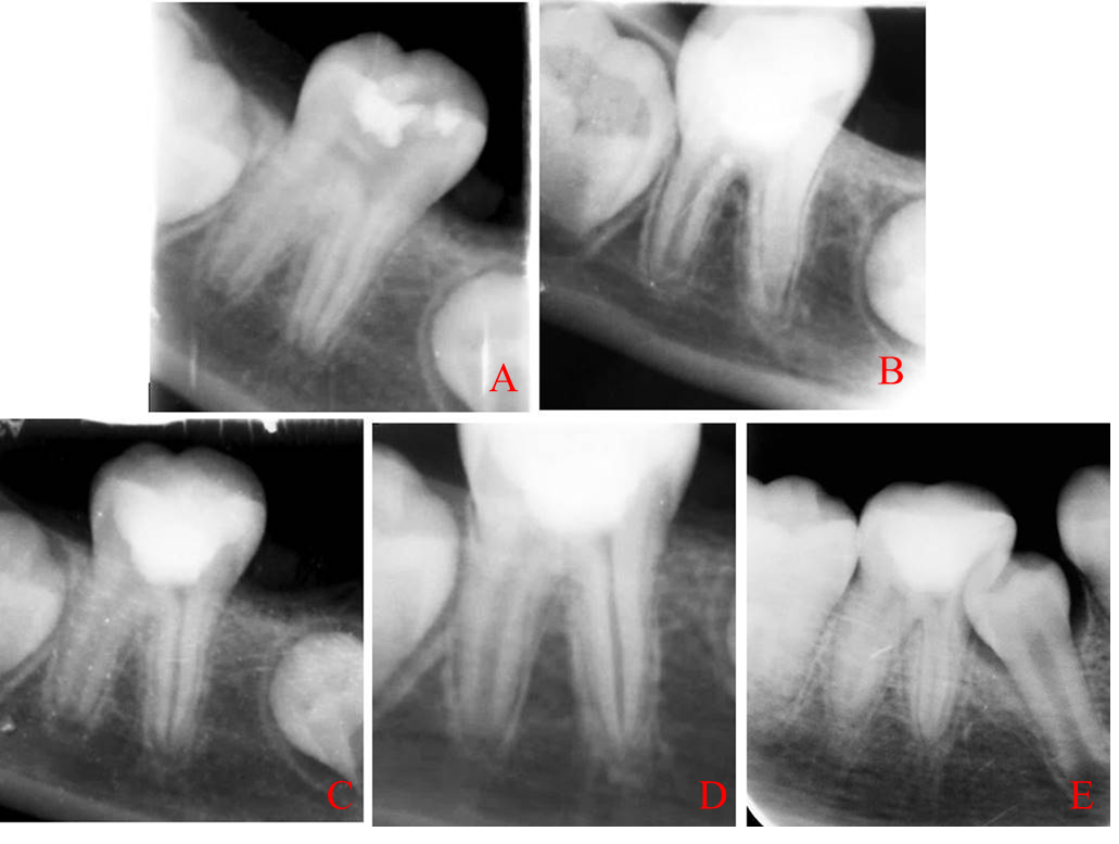 Examples of X-rays taken in non-symptomatic apical periodontitis 
group at the beginning of treatment and during follow-up. (A) initial, (B) 
immediately after surgery, (C) 3 months follow-up, (D) 6 months follow-up, (E) 12 
months follow-up.