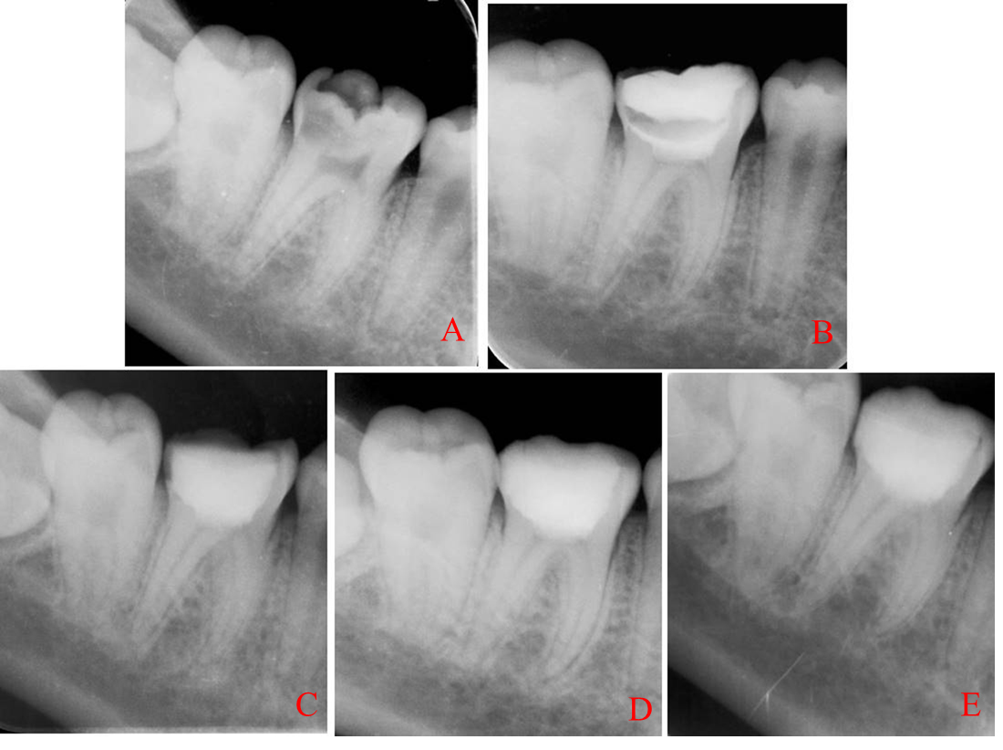 Examples of X-rays taken in non-symptomatic apical periodontitis 
group at the beginning of treatment and during follow-up. (A) initial, (B) 
immediately after surgery, (C) 3 months follow-up, (D) 6 months follow-up, (E) 12 
months follow-up.