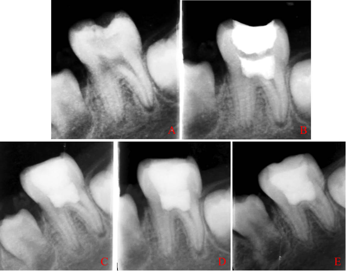 Examples of X-rays taken in symptomatic apical periodontitis 
group at the beginning of treatment and during follow-up. (A) initial, (B) 
immediately after surgery, (C) 3 months follow-up, (D) 6 months follow-up, (E) 12 
months follow-up.