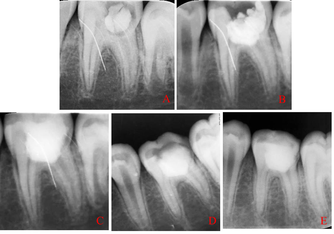 Examples of X-rays taken in symptomatic apical periodontitis 
group at the beginning of treatment and during follow-up. (A) initial, (B) 
immediately after surgery, (C) 3 months follow-up, (D) 6 months follow-up, (E) 12 
months follow-up.