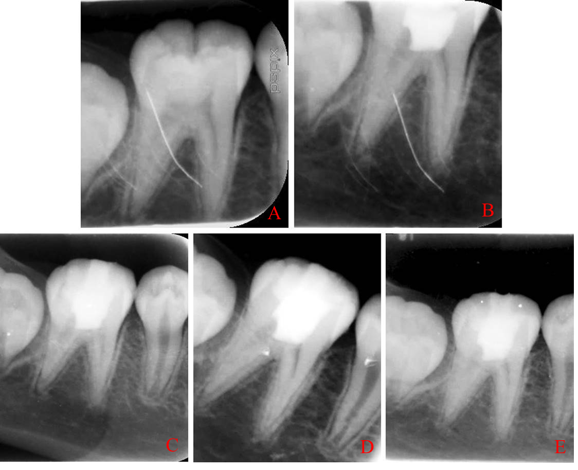 Examples of X-rays taken in symptomatic apical periodontitis 
group at the beginning of treatment and during follow-up. (A) initial, (B) 
immediately after surgery, (C) 3 months follow-up, (D) 6 months follow-up, (E) 12 
months follow-up.