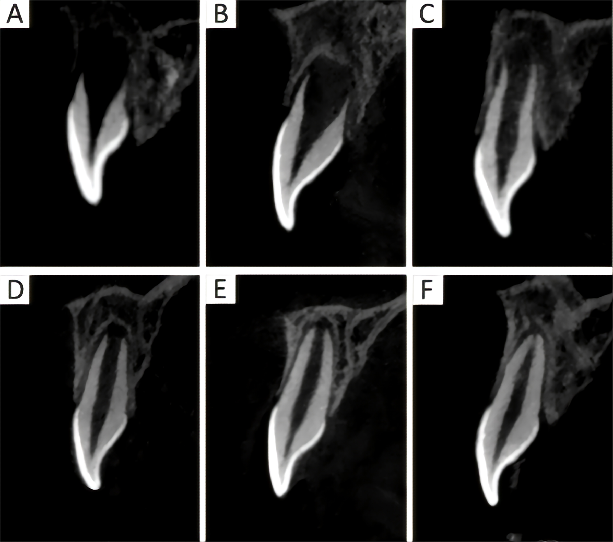 Stages of tooth root development. (A) Tooth development at
Nolla 6, with complete crown development and the beginning of root development.
(B) Tooth development at Nolla 7, with the root length developed to 1/3. (C,D)
Tooth development at Nolla 8, with the root length developed to 2/3. (E) Tooth
development at Nolla 9, with the root length nearing completion, and a larger
apical foramen. (F) Tooth development at Nolla 10, with the root length
essentially complete, and a reduced apical foramen.
