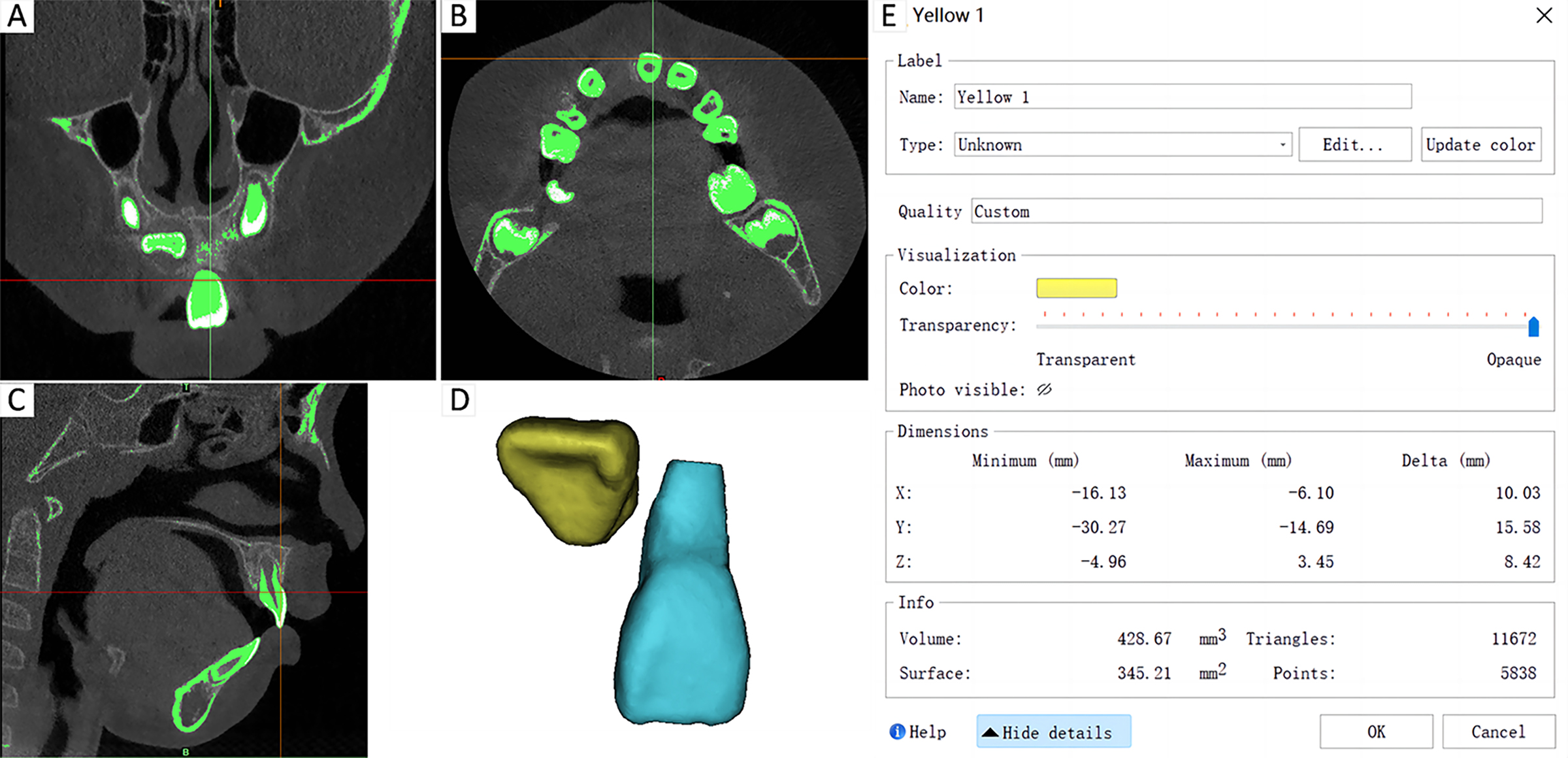 Mimics calculates tooth volume and surface area. (A–C)
Establishment of the Initial Mask. (D) Separation of Impacted and Control Teeth,
Filling of Cavities to Generate a New Mask. (E) Acquisition of Volume and Surface
Area of the Impacted Teeth.
