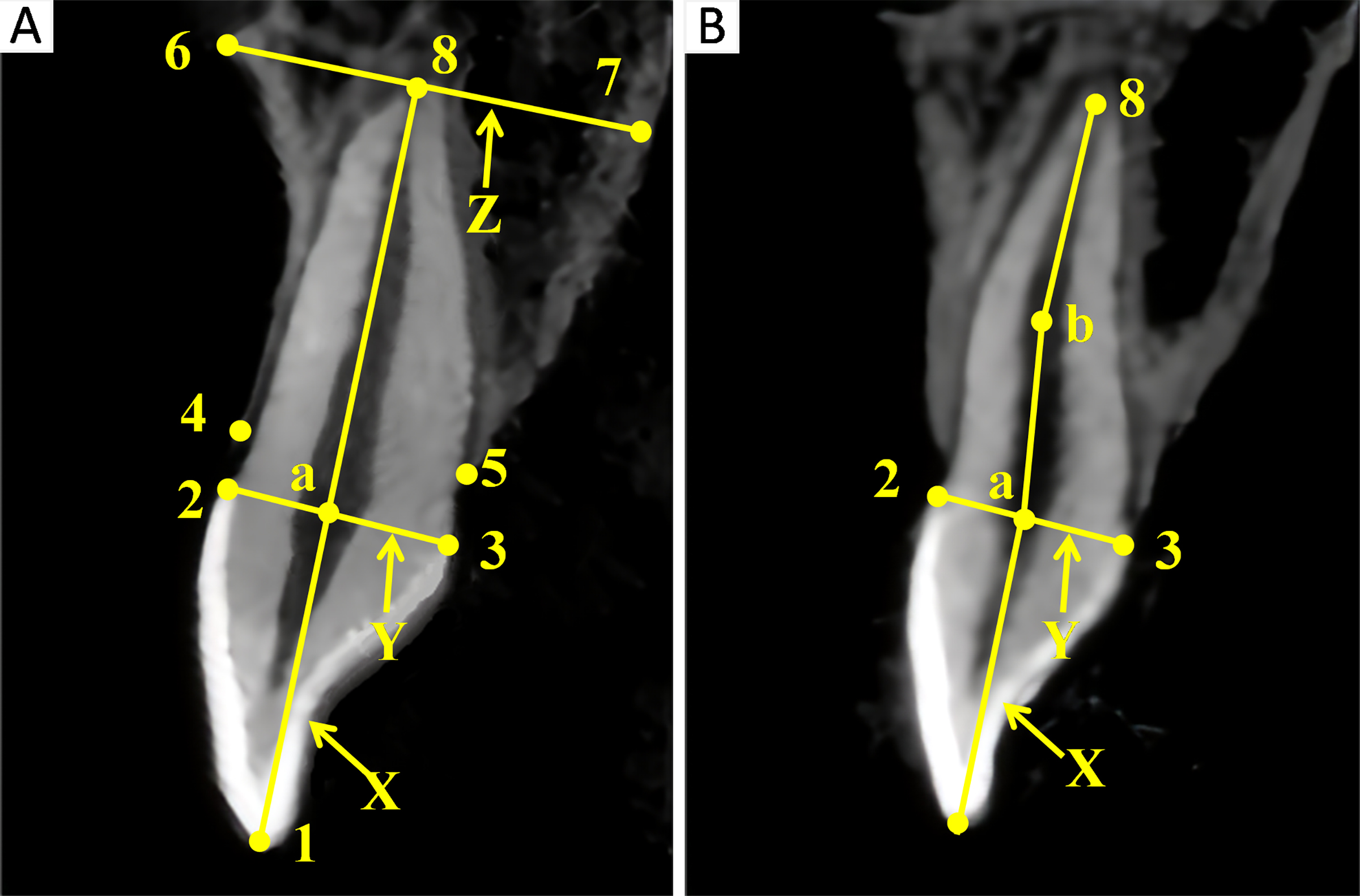 Description of relevant points and lines. (A) Measurement of
the Mid-Sagittal View of the Tooth. (B) Measurement of the Root Length of a
Curved Root Tooth Requires Rotation of the Image, Measuring Along the a-b-8 Line.
(1) Midpoint of the Incisal Edge; (2) Labial Enamel-Cement Junction Point; (3)
Palatal Enamel-Cement Junction Point; (4) Labial Alveolar Crest Point; (5)
Palatal Alveolar Crest Point; (6) Intersection Point of Labial Alveolar Bone
Cortex and Perpendicular to the Long Axis of the Tooth; (7) Intersection Point of
Palatal Alveolar Bone Cortex and Perpendicular to the Long Axis of the Tooth; (8)
Apex Point; X: Long Axis of the Incisor Tooth Body; Y: Line Connecting Points 2
and 3; (Z) Line Connecting Points 6 and 7; (a) Intersection Point of Line X and
Line Y; (b) Midpoint of the Root Bending Point.