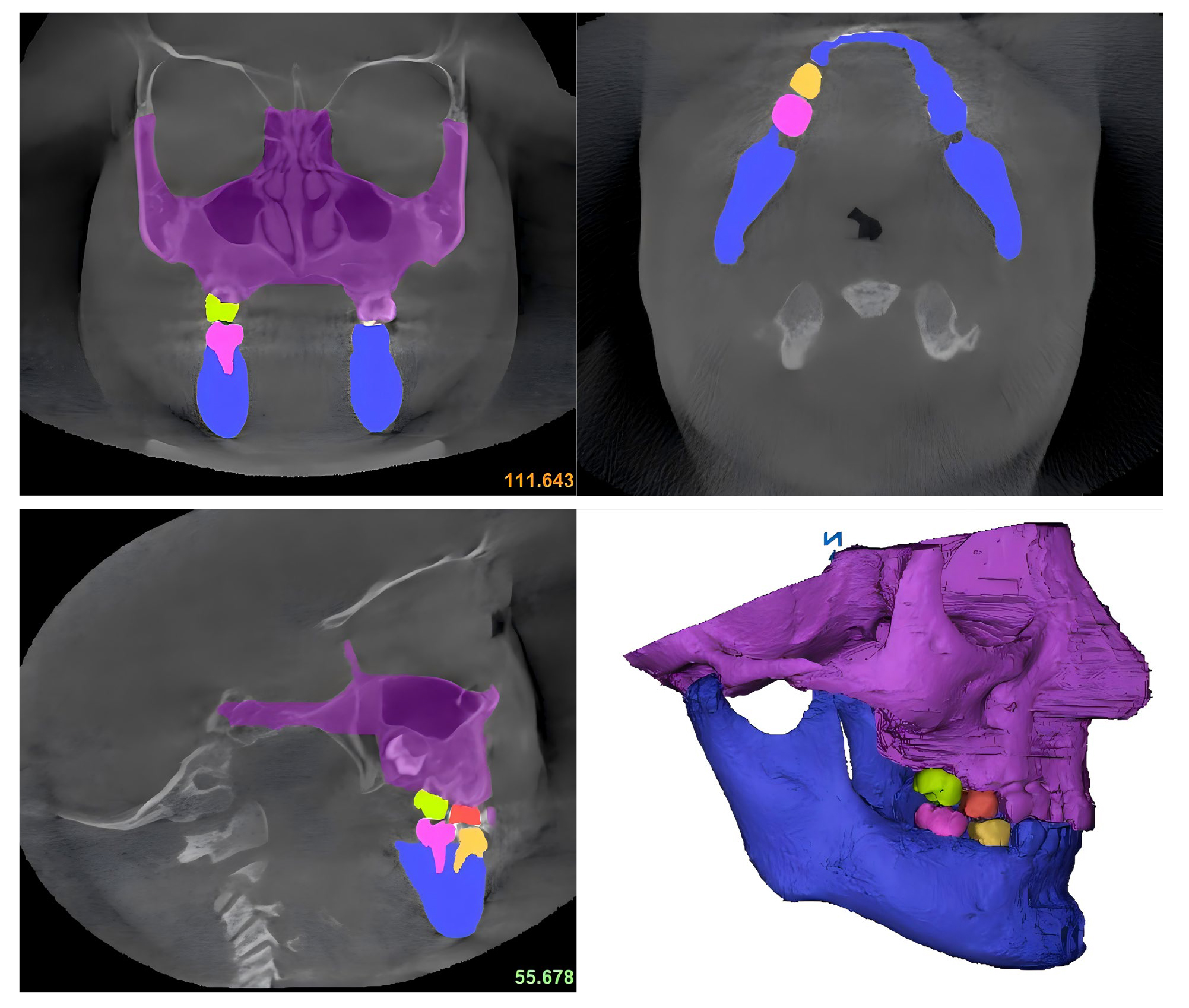 CBCT image extraction and 
preliminary model construction.