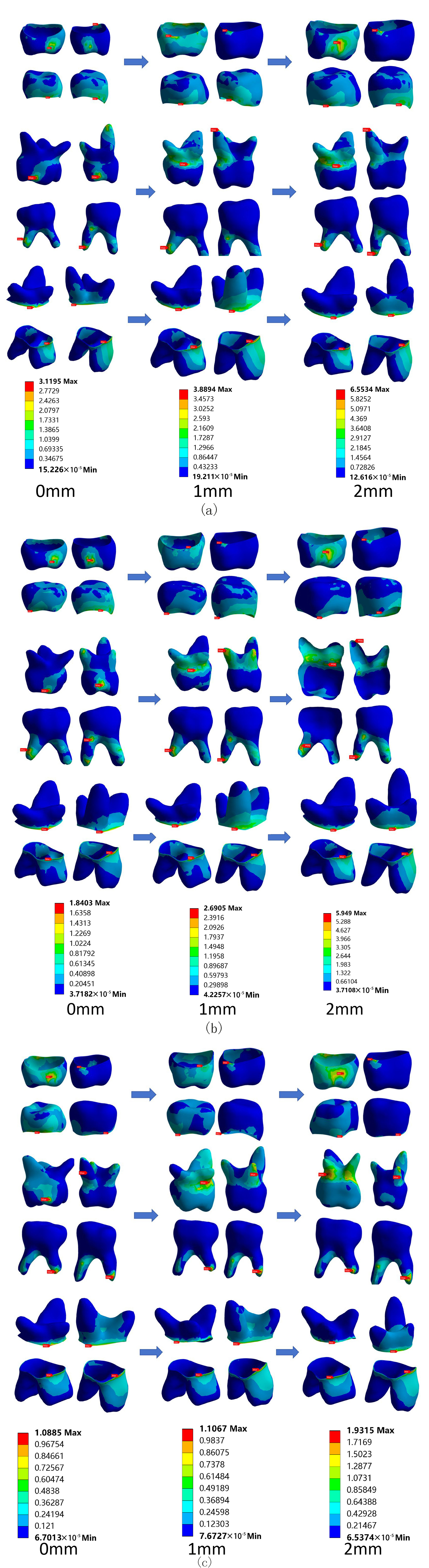 Stress nephogram illustrating changes in occlusal height and 
load angle after SSCs have repaired the first and second deciduous molars on the 
right maxilla and mandible. (a) 0°, (b) 45°, (c) 90° 
Load.