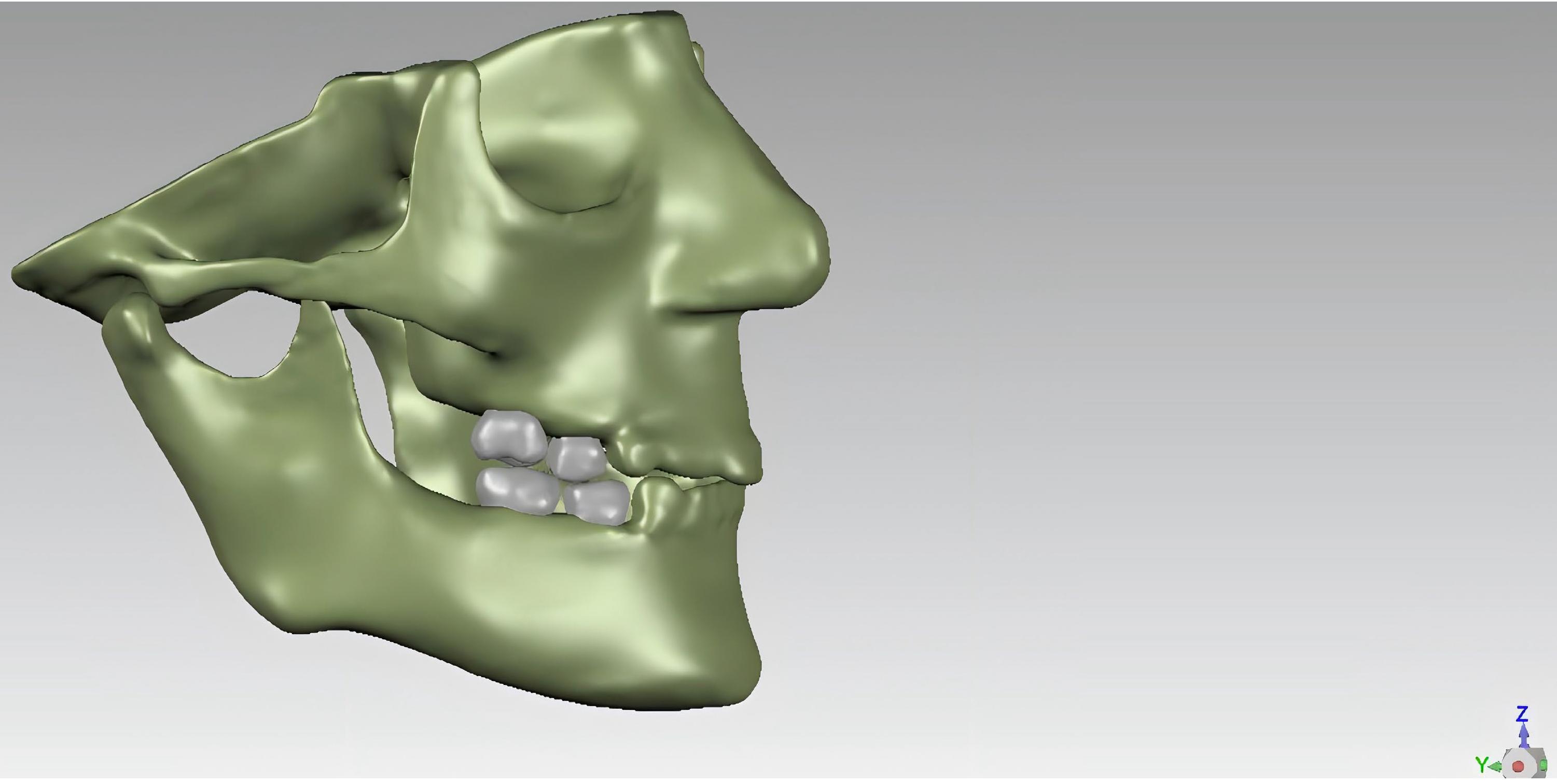 Solidified models of the Maxilla, mandible 
and teeth.